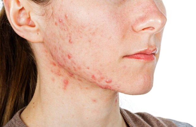 A acne da mulher adulta