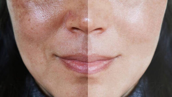 Melasma