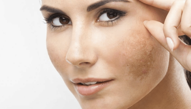 Melasma